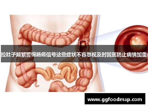 拉肚子频繁警惕肠癌信号这些症状不容忽视及时就医防止病情加重